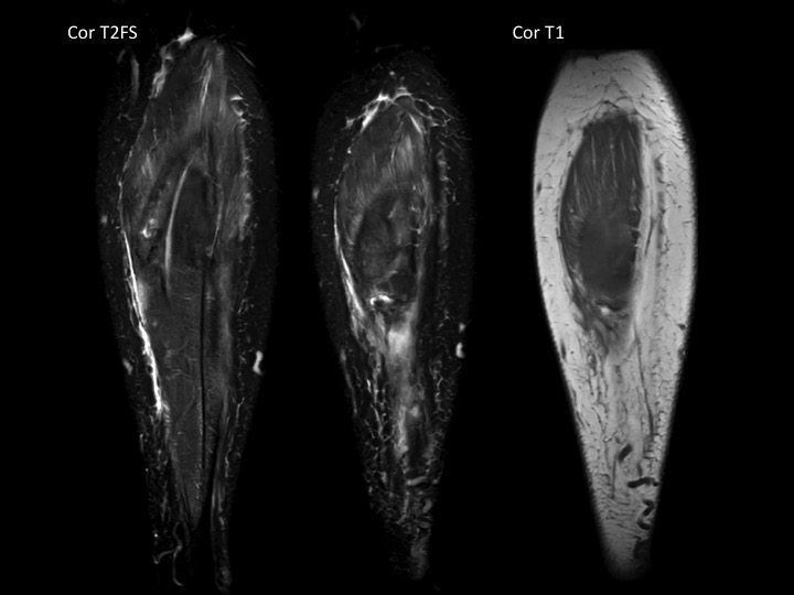 Figure 3 for case medial head of gastrocnemius muscle ( RID2921 )